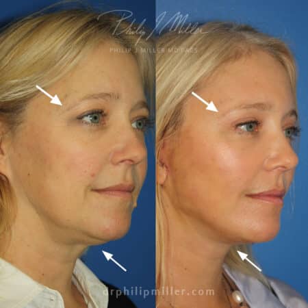 NatraLift facelift with brow lift to rejuvenate the entire face by Dr. Miller