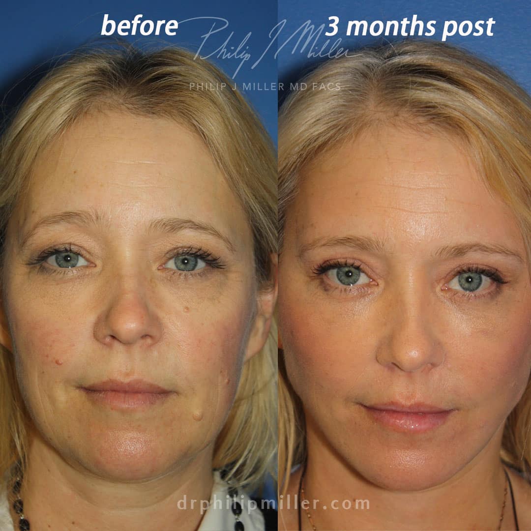 NatraLift facelift with brow lift to rejuvenate the entire face by Dr. Miller. After surgery, brow looks lifted, eyes look refreshed, and jawline is more defined.