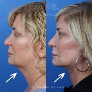 Facelift to address skin sagging and loss of volume by Dr. Miller. After surgery, patient has a more defined jawline and cheekbones and looks refreshed and more youthful.