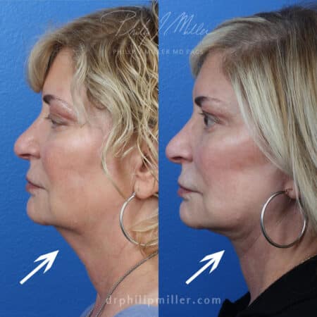 Facelift to address skin sagging and loss of volume by Dr. Miller