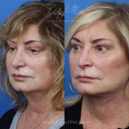 Facelift to address skin sagging and loss of volume by Dr. Miller