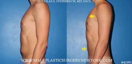 Gynecomastia treatment and liposuction with body banking to pecs by Dr. Steinbrech