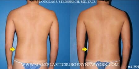 Gynecomastia treatment and liposuction with body banking to pecs by Dr. Steinbrech