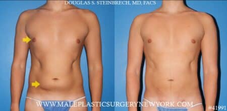 Gynecomastia treatment and liposuction with body banking to pecs by Dr. Steinbrech