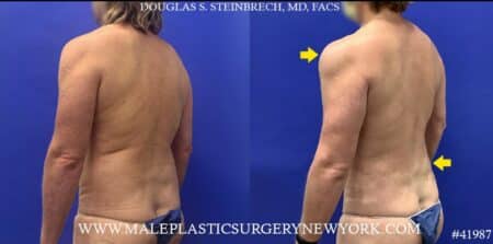 Liposuction with body banking to pecs, shoulders, and traps by Dr. Steinbrech