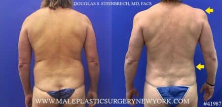 Liposuction with body banking to pecs, shoulders, and traps by Dr. Steinbrech