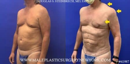 Liposuction with body banking to pecs, shoulders, and traps by Dr. Steinbrech