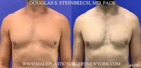 Liposuction and gynecomastia removal with body banking to pecs by Dr. Steinbrech