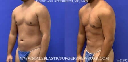 Liposuction with body banking to pecs and shoulders by Dr. Steinbrech