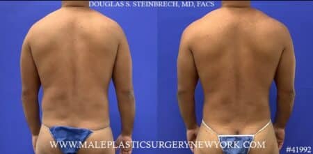 Liposuction with body banking to pecs and shoulders by Dr. Steinbrech