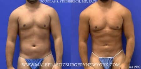 Liposuction with body banking to pecs and shoulders by Dr. Steinbrech