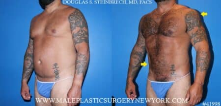 270° Torso Tuck with body banking to the pecs and glutes by Dr. Steinbrech