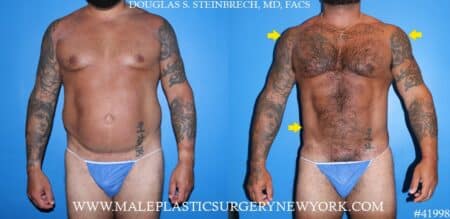 270° Torso Tuck with body banking to the pecs and glutes by Dr. Steinbrech