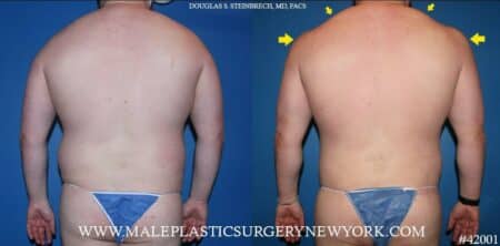 Body banking with back lift to sculpt torso by Dr. Steinbrech