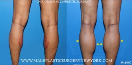 Calf implants, medial and lateral heads, to enhance the lower leg by Dr. Steinbrech