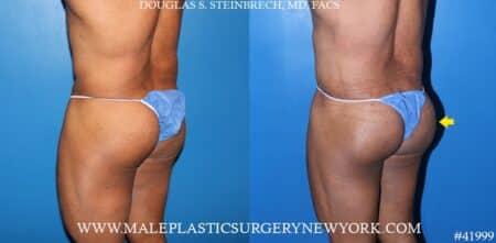 Composite gluteal augmentation with silicone implants and body banking by Dr. Steinbrech