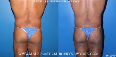 Composite gluteal augmentation with silicone implants and body banking by Dr. Steinbrech