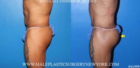 Composite gluteal augmentation with silicone implants and body banking by Dr. Steinbrech