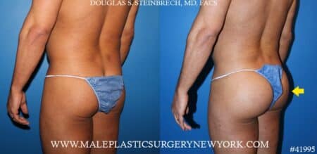 Gluteal augmentation using silicone implants by Dr. Steinbrech