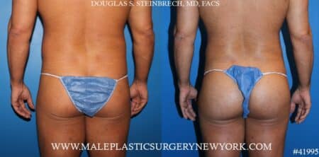 Gluteal augmentation using silicone implants by Dr. Steinbrech