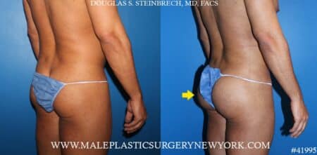 Gluteal augmentation using silicone implants by Dr. Steinbrech