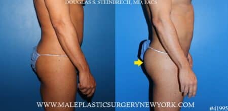 Gluteal augmentation using silicone implants by Dr. Steinbrech