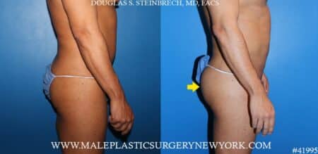 Gluteal augmentation using silicone implants by Dr. Steinbrech