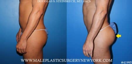 Gluteal augmentation using silicone implants by Dr. Steinbrech