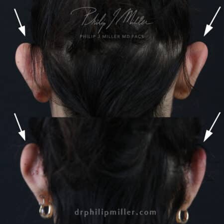 Otoplasty to adjust the position of the ears by Dr. Miller