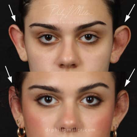 Otoplasty to adjust the position of the ears by Dr. Miller