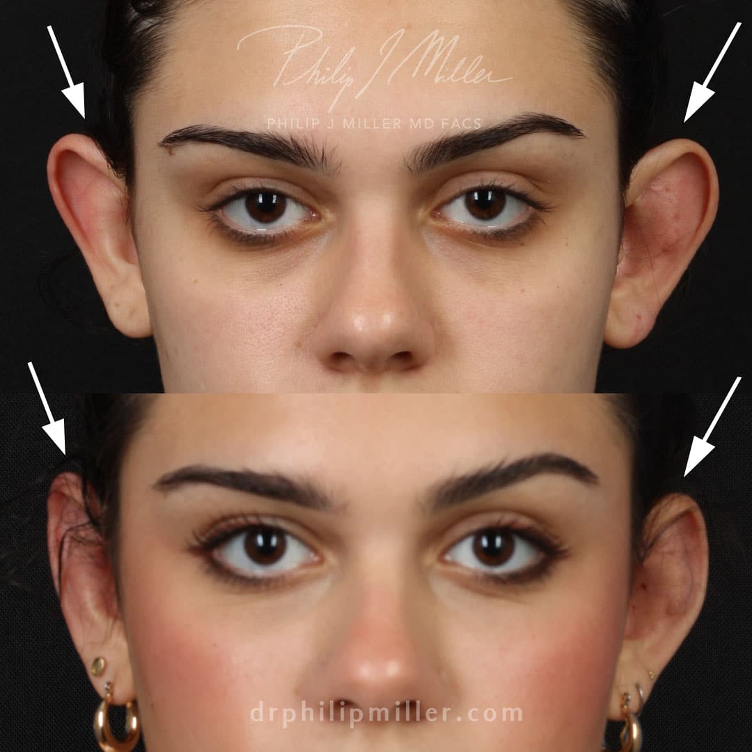 Otoplasty to adjust the position of the ears by Dr. Miller. After surgery, ears are positioned closer to the head so they are less obtrusive.