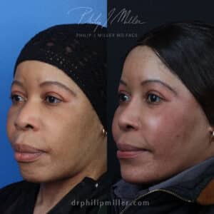 Rhinoplasty, chin implant, and lip reduction to improve the facial contour by Dr. Miller. After surgery, jawline is more contoured and features are more proportionate.