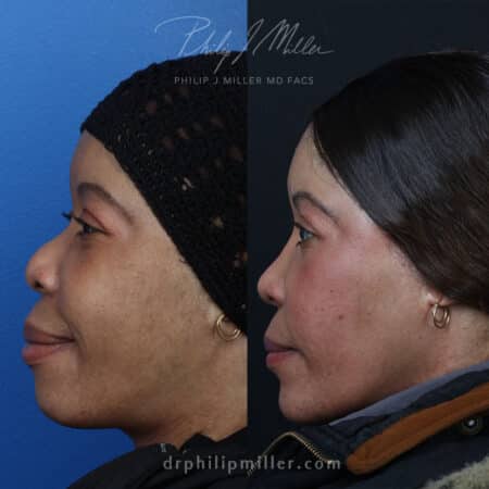 Rhinoplasty, chin implant, and lip reduction to improve the facial contour by Dr. Miller