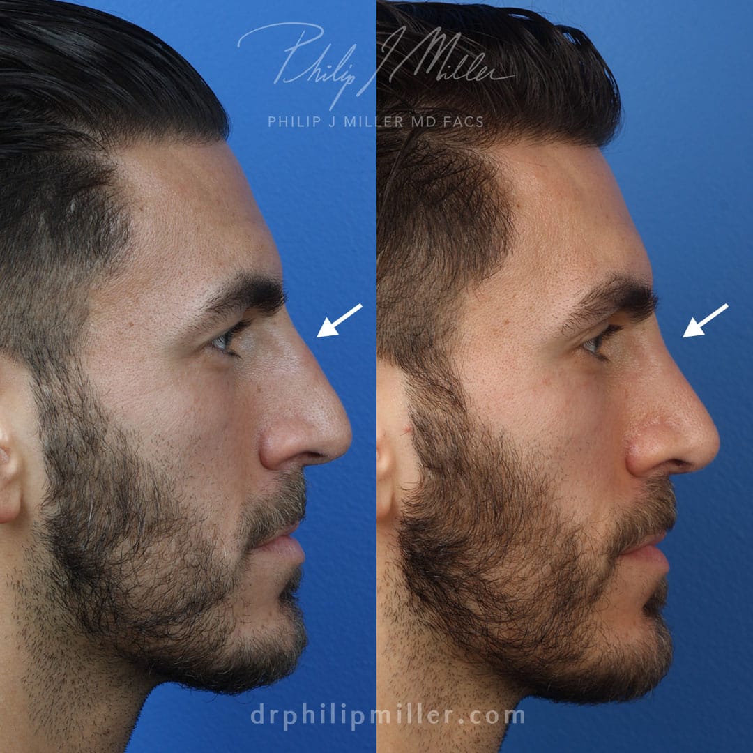 Rhinoplasty to adjust nasal bridge by Dr. Miller. After surgery, small bump and top of bridge is gone to improve patient's profile.