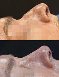 Rhinoplasty to improve patient profile by Dr. Miller. After surgery, nasal hump is gone and tip is more refined.