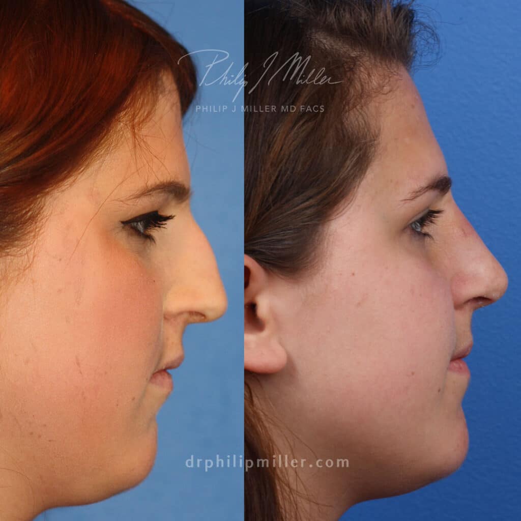 Rhinoplasty to remove a bump from the nasal bridge and enhance the facial profile of a female patient.