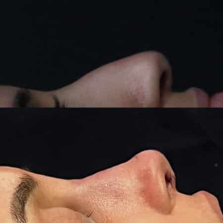 Rhinoplasty to refine the nasal bridge and tip by Dr. Miller