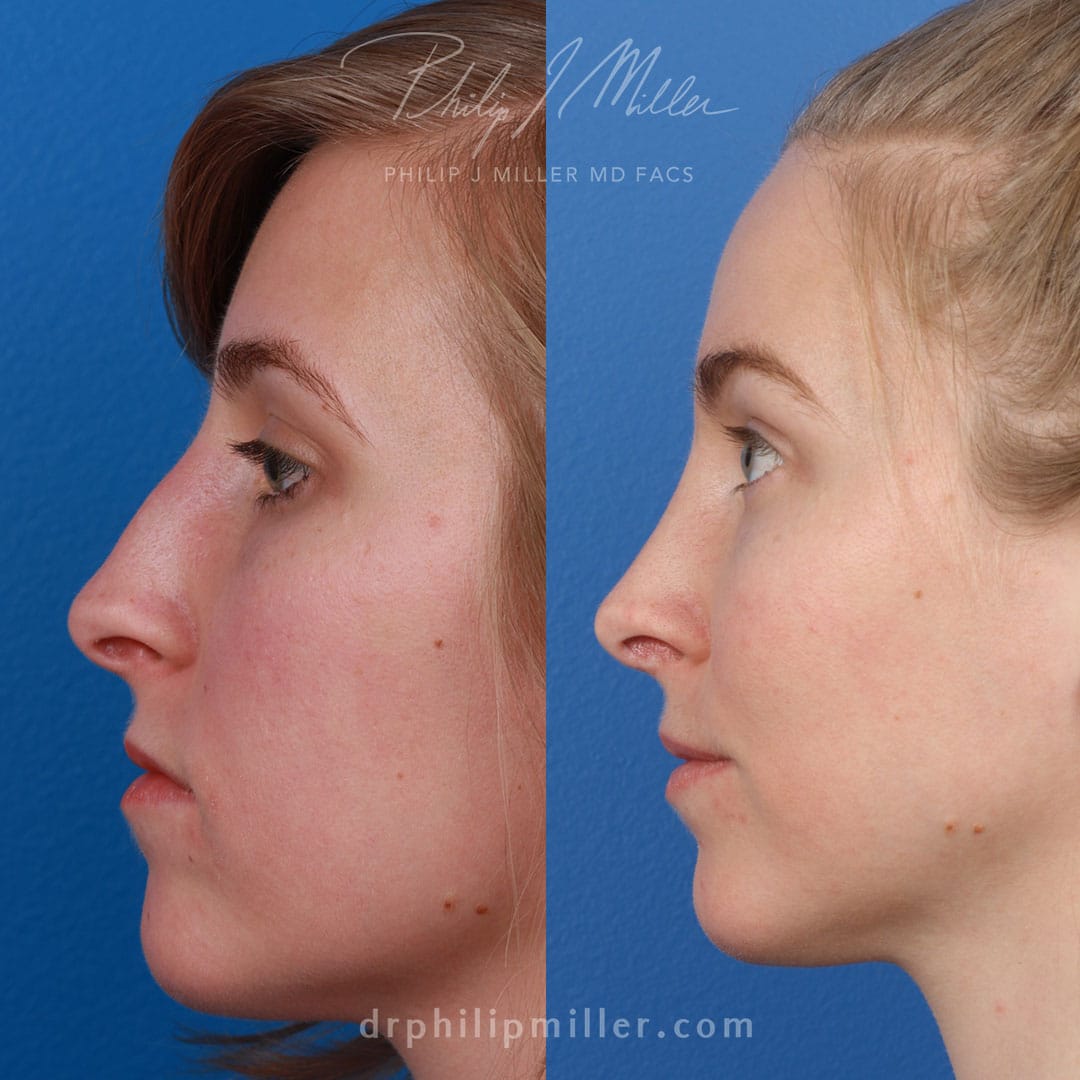 Rhinoplasty to refine nasal bridge by Dr. Miller. Surgery removes hump from nasal bridge to create a more aesthetically pleasing patient profile.