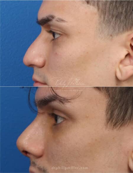 Rhinoplasty to straighten the bridge and rotate the tip by Dr. Miller