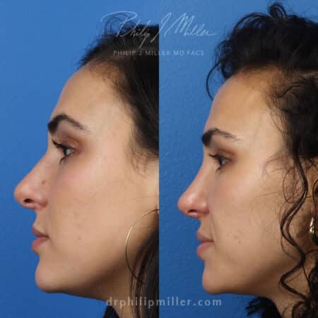 Rhinoplasty to straighten the bridge and improve the tip by Dr. Miller