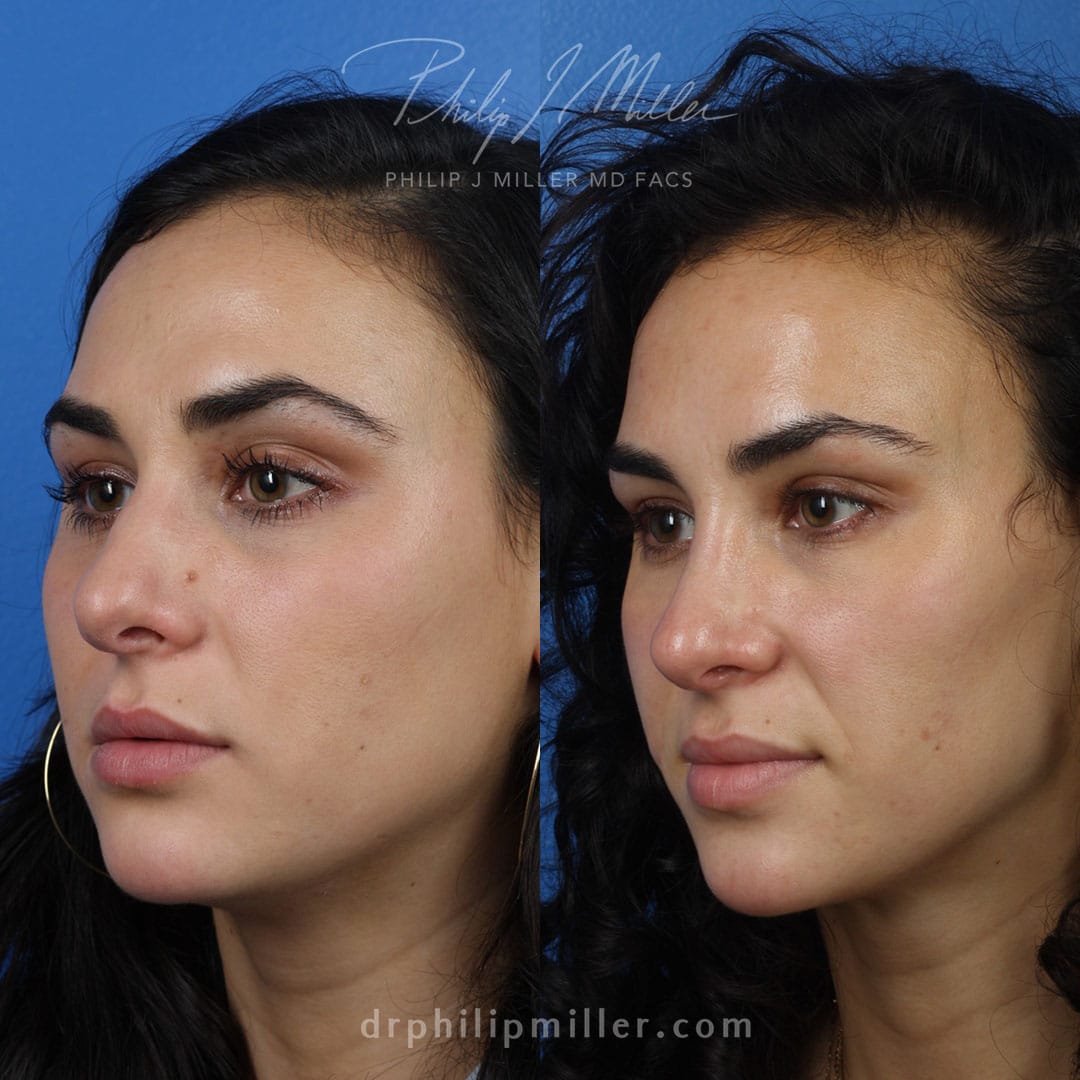 Rhinoplasty to straighten the bridge and improve the tip by Dr. Miller. After surgery, nose shape is improved and nose is more proportionate to the patient's face.