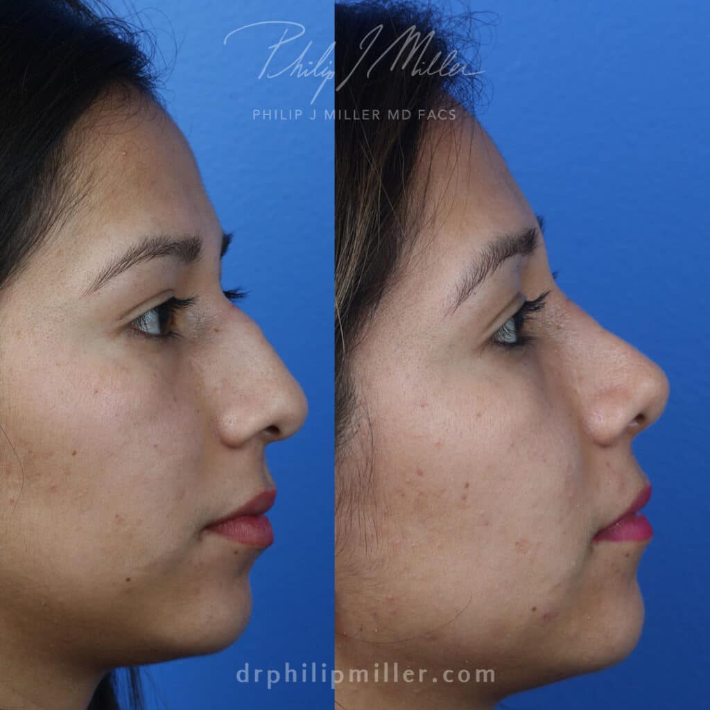 Rhinoplasty to straighten nasal bridge and refine tip of a female patient by Dr. Miller. After surgery, hump is removed from bridge and tip has more aesthetically pleasing shape.