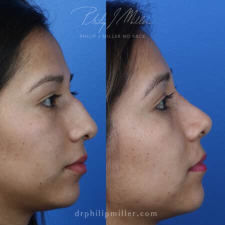 Rhinoplasty to Improve Nasal Bridge and Tip by Dr. Miller