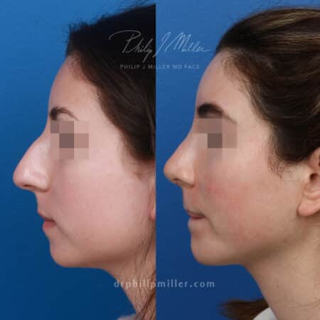 Rhinoplasty to adjust the nasal tip and remove dorsal hump by Dr. Miller