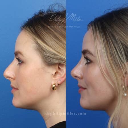 Rhinoplasty to refine the nasal bridge and tip by Dr. Miller