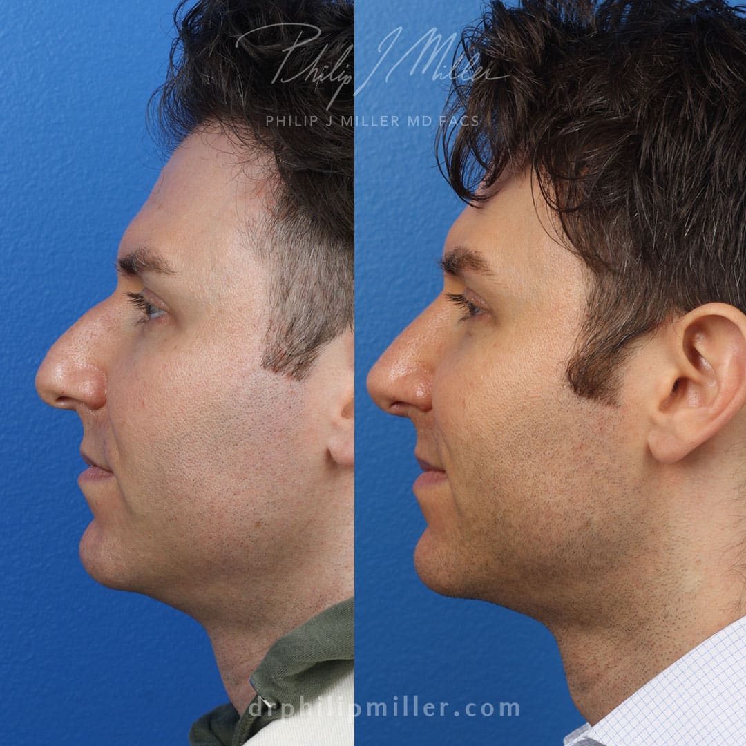 Rhinoplasty to adjust the nasal bridge and raise the tip by Dr. Miller. After surgery, nose is more proportionate to improve facial profile overall.