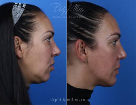 Rhinoplasty with chin implant to improve facial contour by Dr. Miller