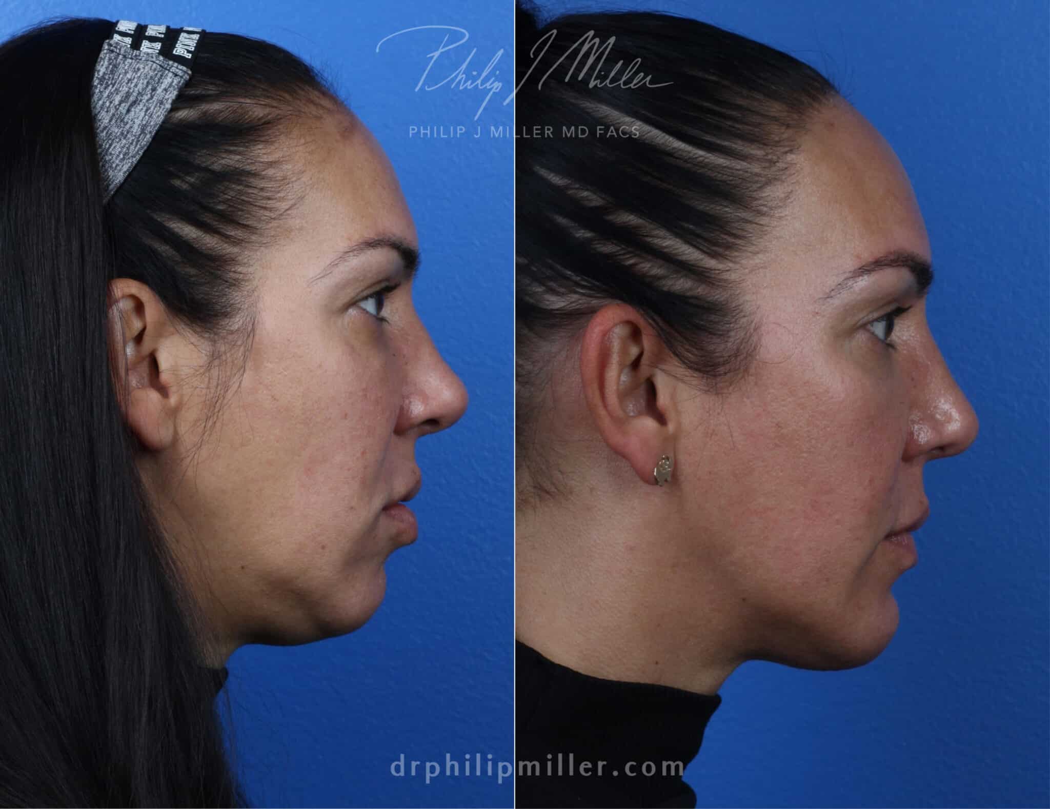 double chin removal before and after