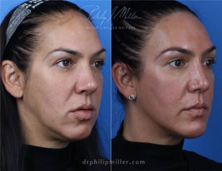 Rhinoplasty with chin implant to improve facial contour by Dr. Miller