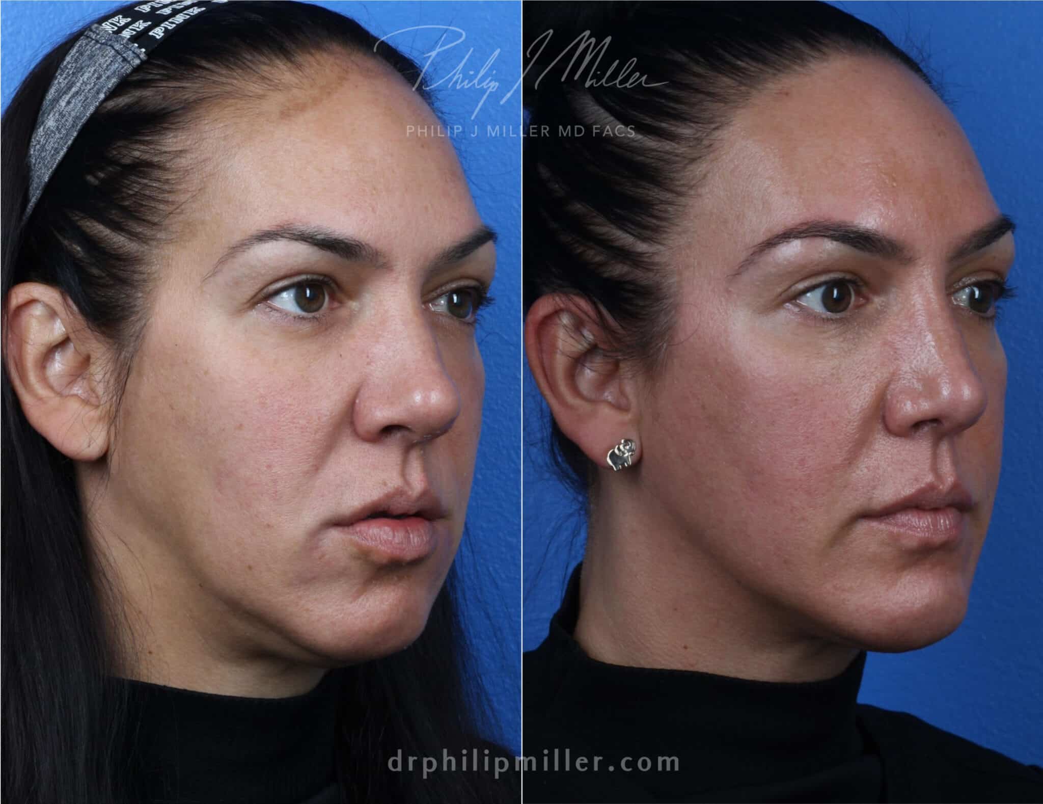 Rhinoplasty with chin implant to improve facial contour by Dr. Miller. After surgery, patient's jawline is more defined and nose is more proportionate to other facial features.